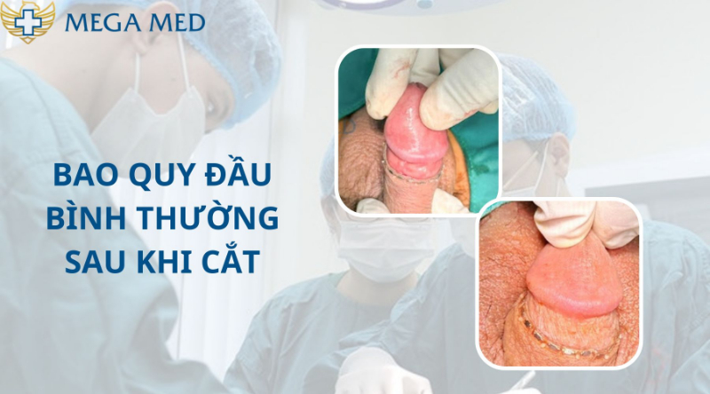 Hình ảnh bao quy đầu bình thường sau khi cắt xong